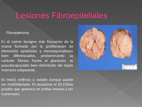 cambios fibroquistico de mama