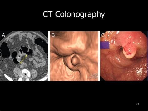 Can a CT scan detect any abnormal lump in colon?   Quora