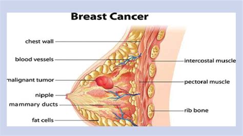 Can benign breast tumors become cancerous Breast cancer ...