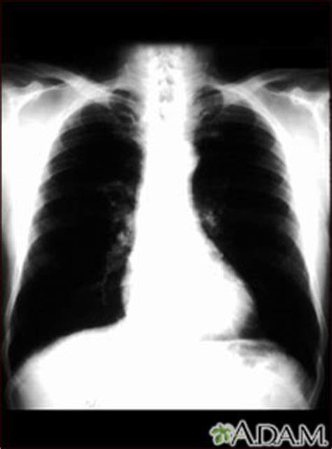 Cáncer bronquial   radiografía de tórax: MedlinePlus ...