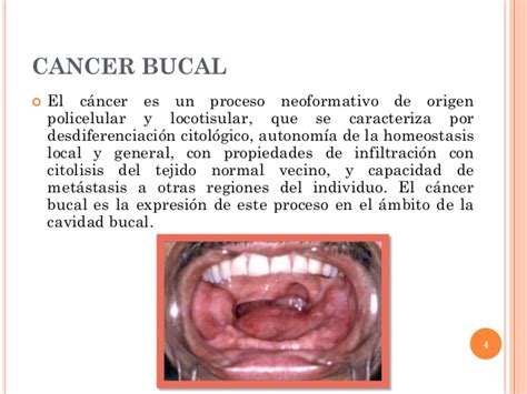 Cancer bucal