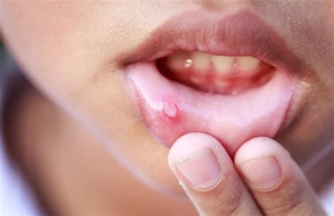 Câncer bucal: o que é, como prevenir e tratar Silvia Bastos