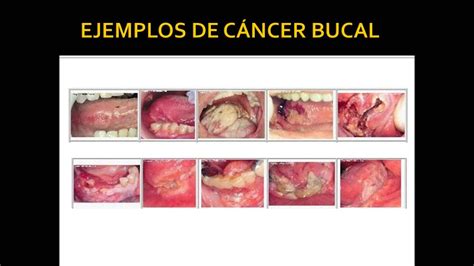 Cancer bucal   YouTube