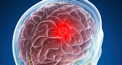 Cancer cerebral: La enfermedad que mato a interprete de ...