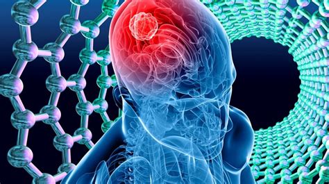 Cancer cerebral: La enfermedad que mato a interprete de ...