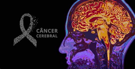 Câncer cerebral: maio é o mês de conscientização do tumor ...