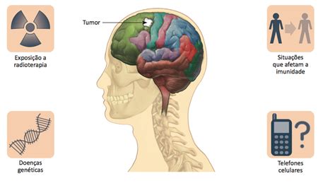 Câncer Cerebral: sintomas, diagnóstico e tratamento ...