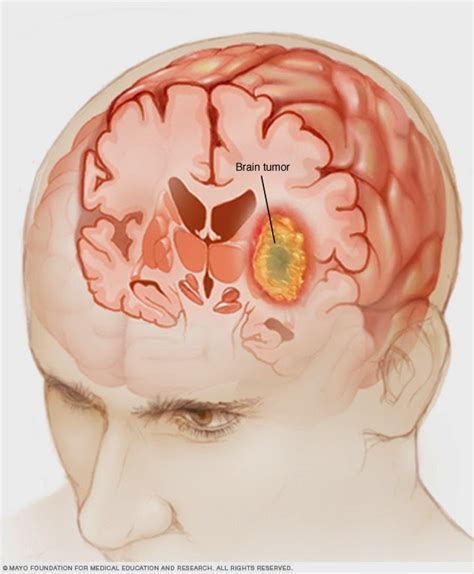Câncer cerebral   tipos de tumor cerebral e opções de ...