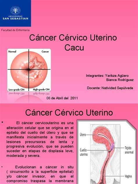 Cáncer Cérvico Uterino | PDF