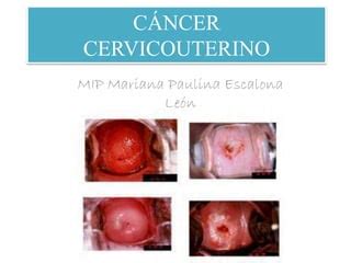 Cáncer cervicouterino en el primer nivel | PPT