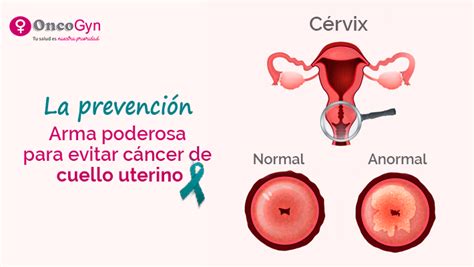 Cancer Cervicouterino Manifestaciones Clinicas   Golpari Sial