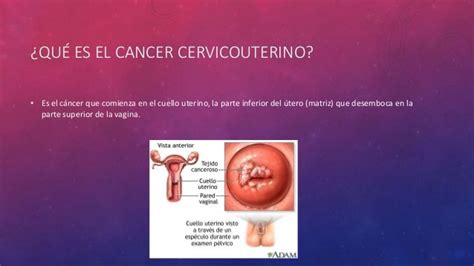Cancer cervicouterino