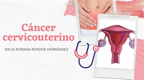 Cáncer Cervicouterino   YouTube