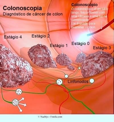 Cancer colon fase 4. Definition de papillomavirus humains