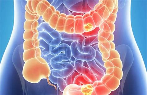 Cáncer Colorrectal  colon : causas, síntomas y tratamiento ...