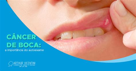 Câncer de boca: a importância do autoexame bucal Dr ...