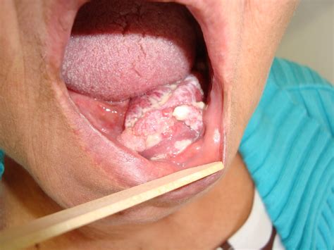 .: Cancer de boca