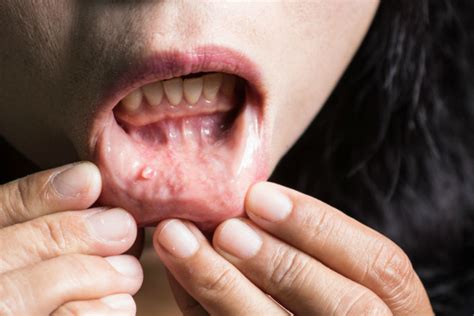 Câncer de boca: sintomas, fotos, tipos, tratamento e mais