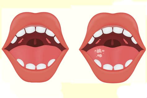 Câncer de boca: sintomas, fotos, tipos, tratamento e mais