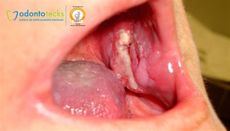 Cáncer de boca, síntomas y prevención | Odontotecks