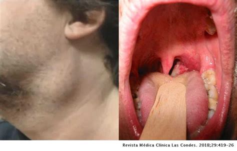 Cáncer de Cabeza y Cuello asociado a Virus Papiloma Humano ...