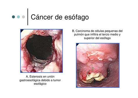 Cancer De Celulas T | revolucionario tratamiento del c 225 ...