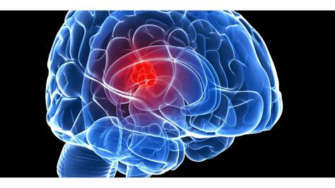 Cáncer de Cerebro – Centro Salvadoreño de Radioterapia