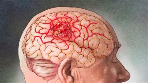 Cáncer de cerebro, tipos y síntomas   Gamma Knife