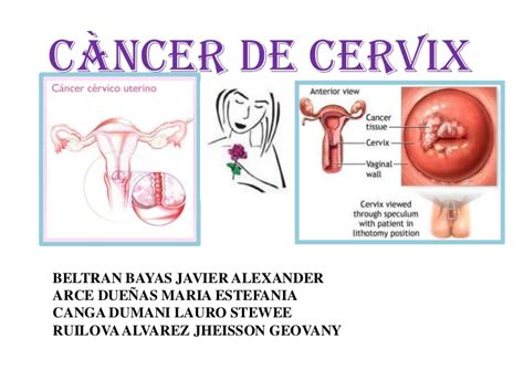 Cancer de cervix