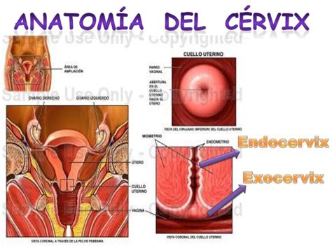 Cancer de cervix