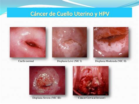 Cancer De Cervix Tratamiento