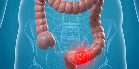 Câncer de colon, causas, sintomas e formas de tratamento!