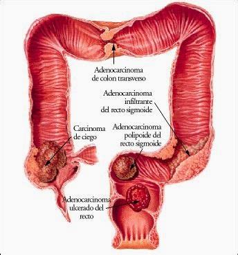 Cáncer de colon, causas, síntomas, prevencion   IMÁGENES ...