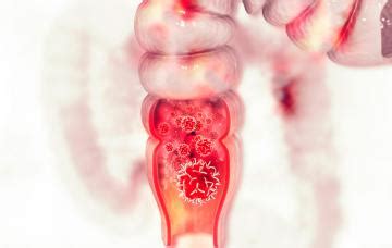 Cáncer de colon Causas, síntomas y tratamiento