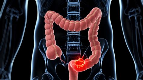 Cáncer de colon: causas, síntomas y tratamientos