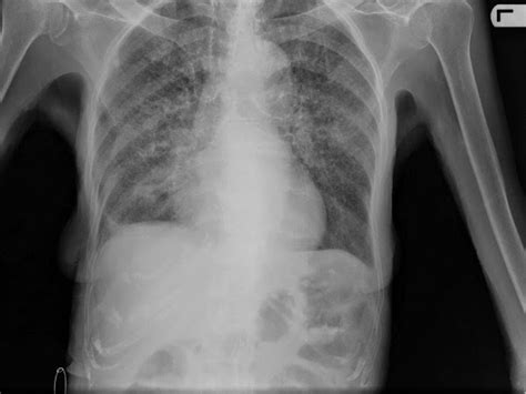 Cáncer de colon con metástasis pulmonar   Salud