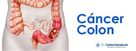 Cancer de colon definicion Febra tifoidă