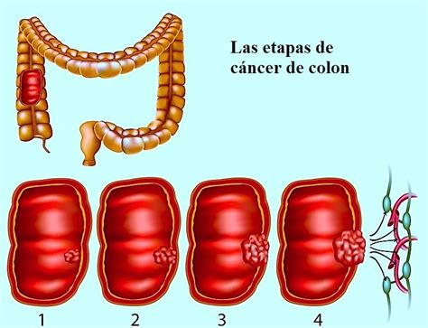 Cáncer de colon: diagnóstico, tratamiento y pronóstico