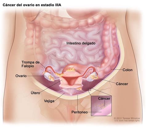 Cancer de colon en la etapa 4, Cancer tratamiento hormonal