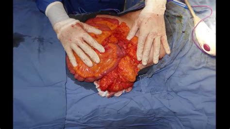 Cáncer de colon. Hemicolectomia derecha  Cirugía radical ...