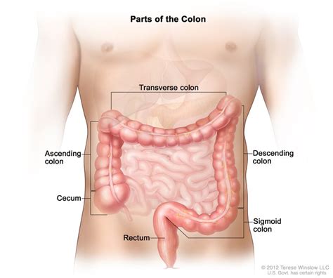 Cancer de colon juvenil, Cancer de colon metacronico ...
