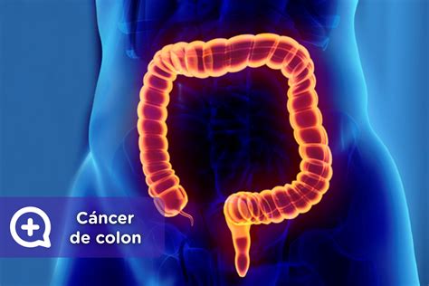 Cáncer de colon: Los síntomas de alarma   mediQuo