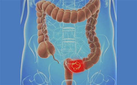 Cáncer de colon: Prevención, causas y tratamiento