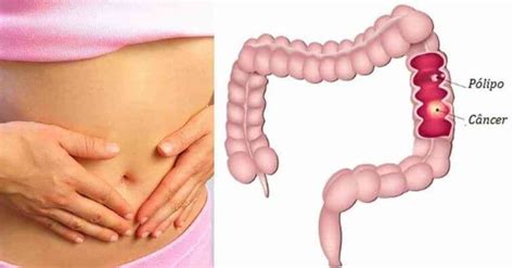 Cáncer de colon: Qué es, factores de riesgo, etapas y ...