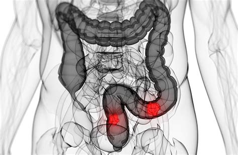 Cáncer de colon: ¿Qué es?   Síntomas, causas y tratamiento