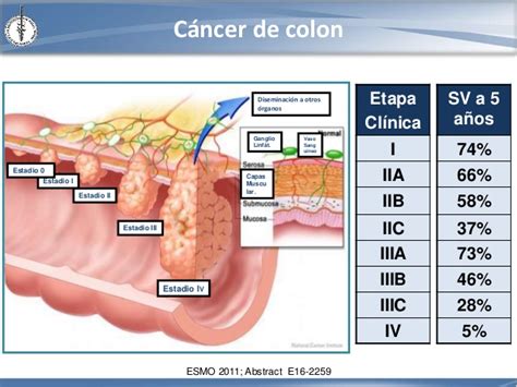Cáncer de colon: Quimioterapia adyuvante