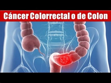 Cancer de Colon   Sintomas, Como se Forma Y Tratamientos ...