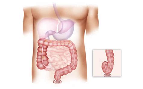 Cáncer de colon, síntomas, tratamientos y supervivencia