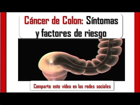 CANCER DE COLON: Síntomas y factores de riesgo del Cancer ...