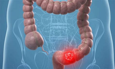 Cáncer de colon: Una enfermedad letal pero previsible y curable | Nexofin